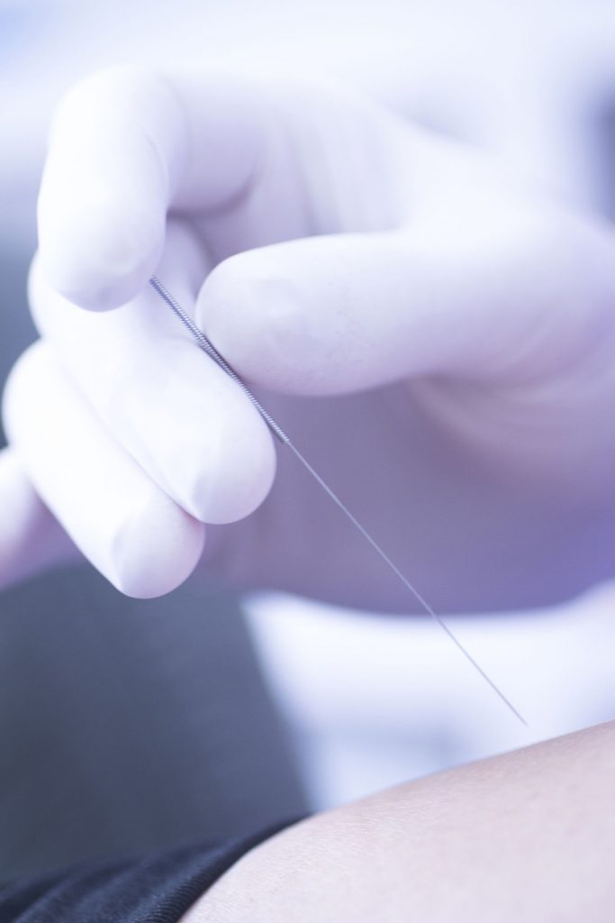 fysiotherapie profit dry needling